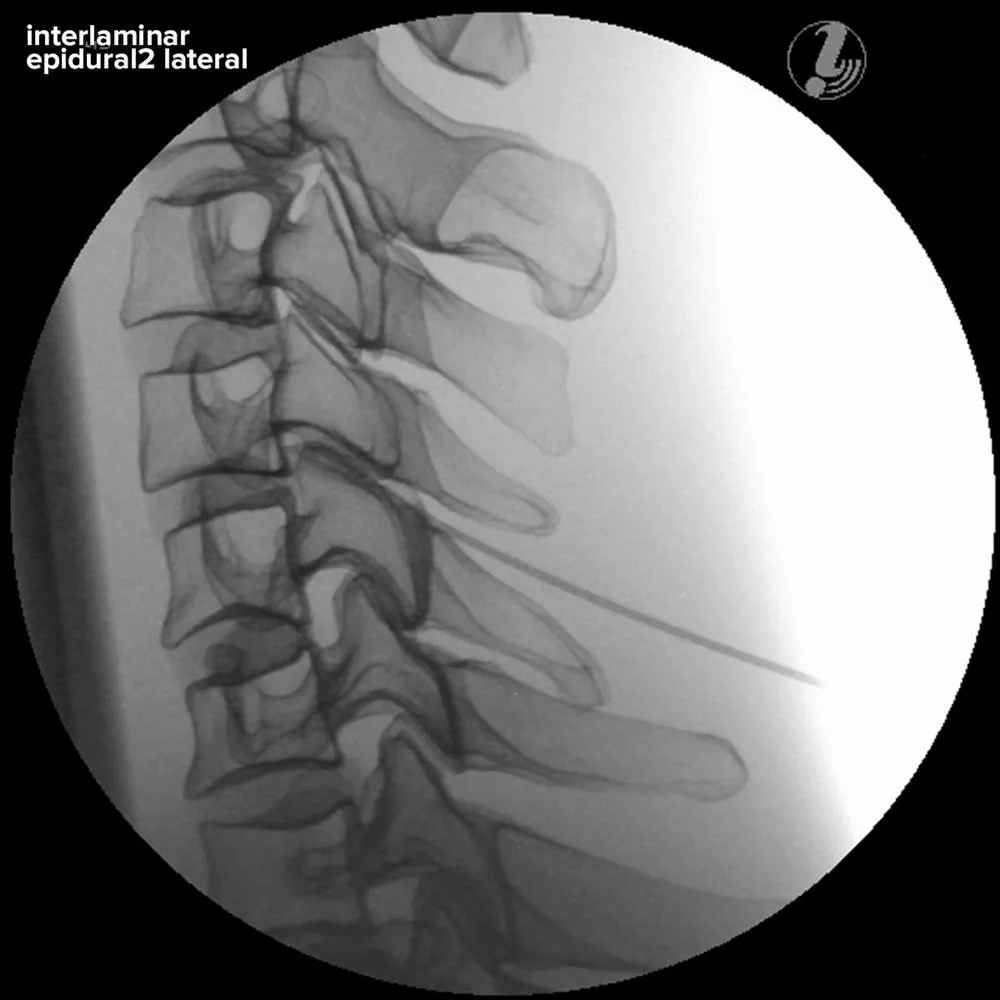 Image Guided Cervical Spine Injection Trainer