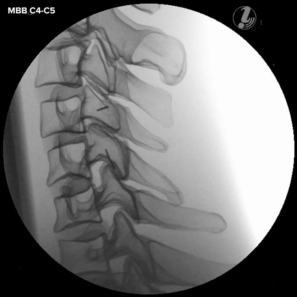 Image Guided Cervical Spine Injection Trainer